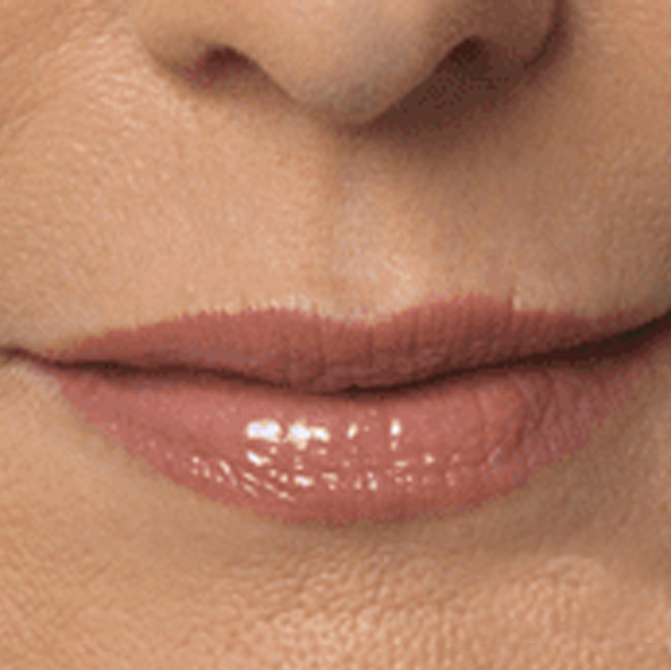 Dermal Filler After Treatment Image