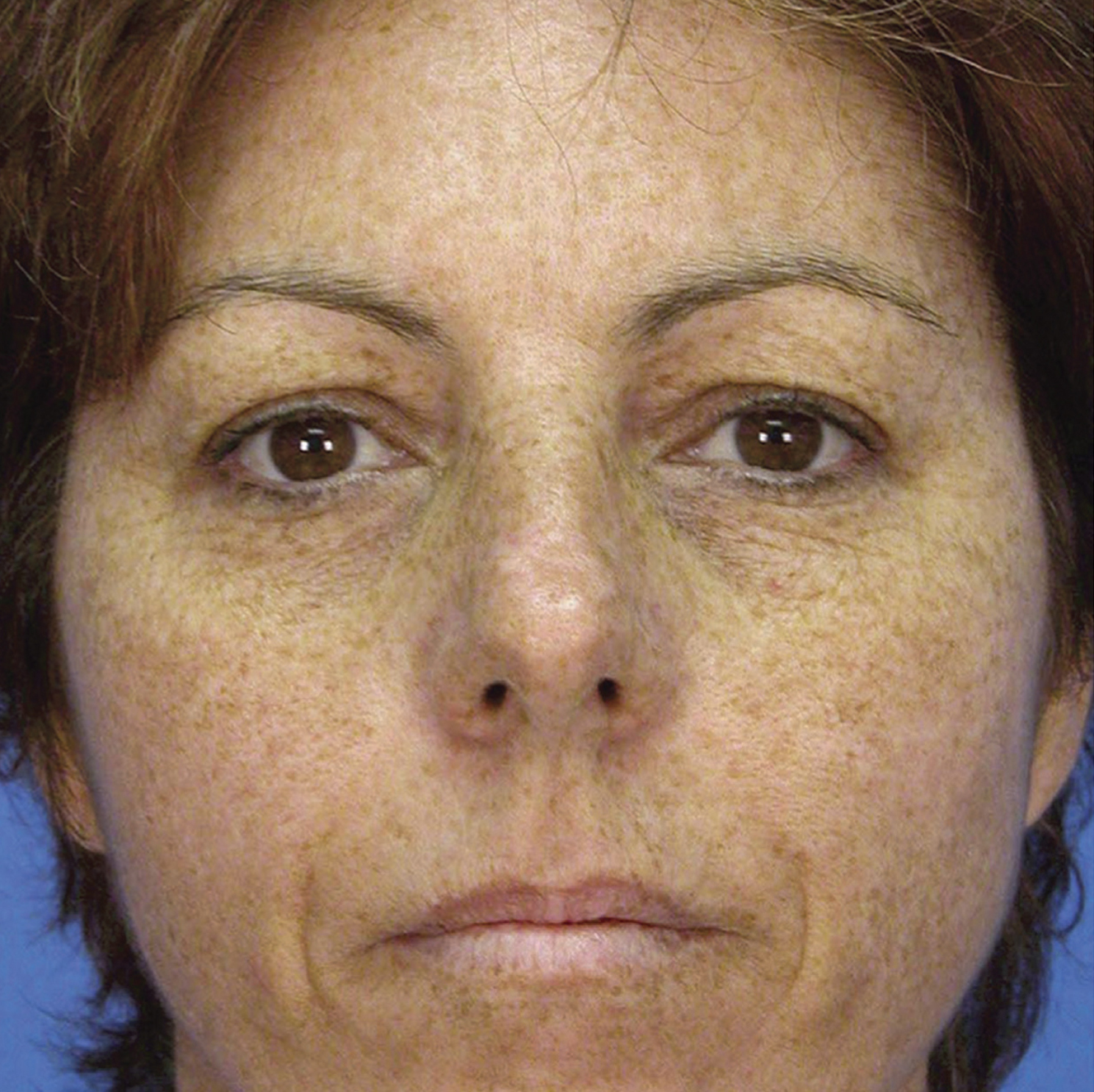 Microlaserpeel Before Treatment Image