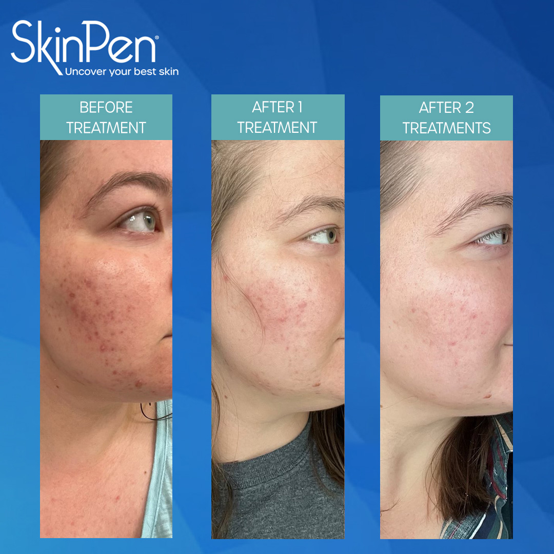 Skinpen Treatment Image