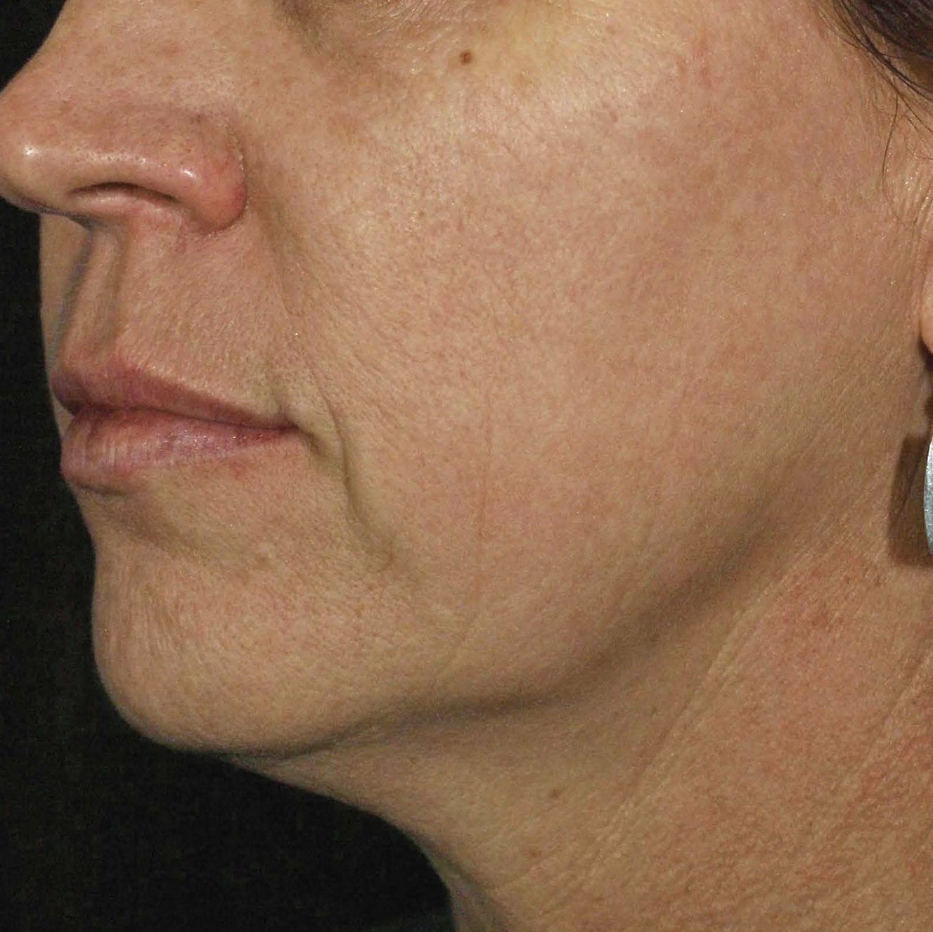 Skintyte After Treatment Image