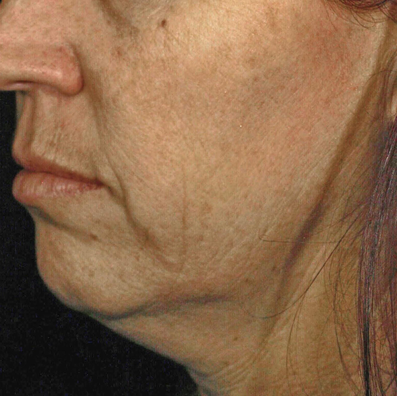 Skintyte Before Treatment Image